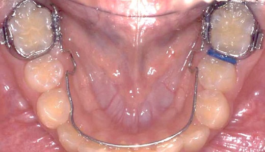 リンガルアーチ