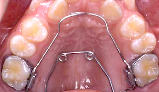 クワドへリックス